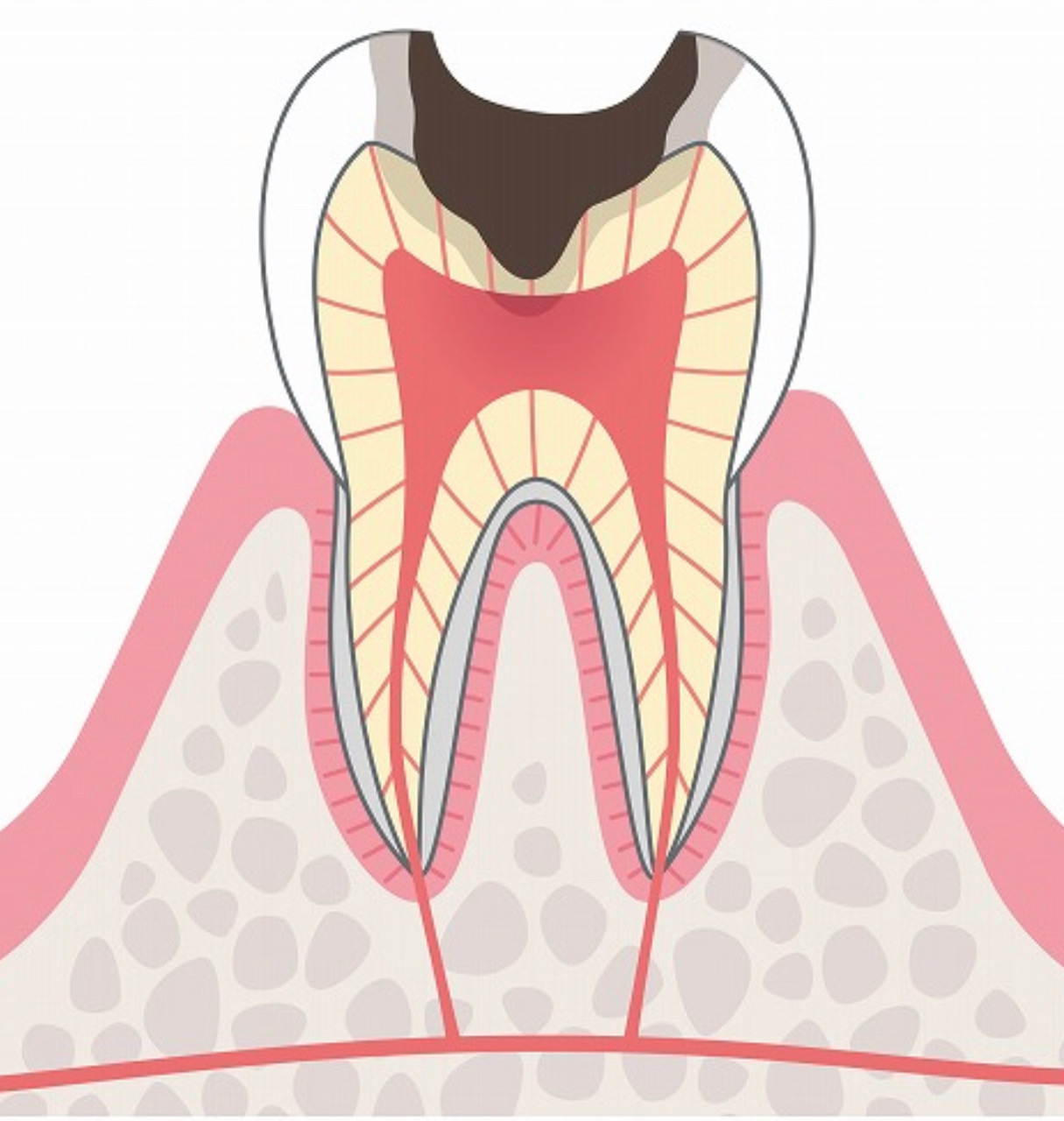 C3の虫歯の画像